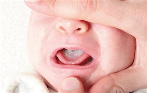 bebeklerde ağız içi yaraları için ilaç